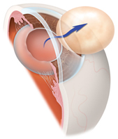 Cataract Surgery Bayside