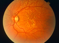 Macular Degeneration Treatment Bayside