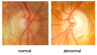 Glaucoma Treatment Bayside